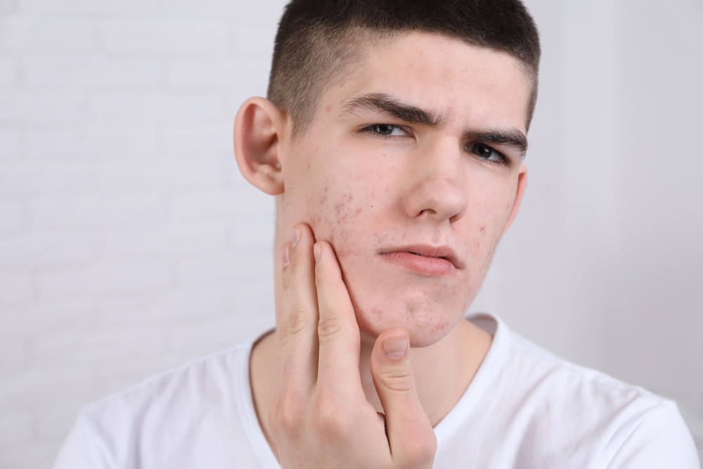 Acne fulminans symptomen: ernstige huidontsteking op het gezicht en borst.